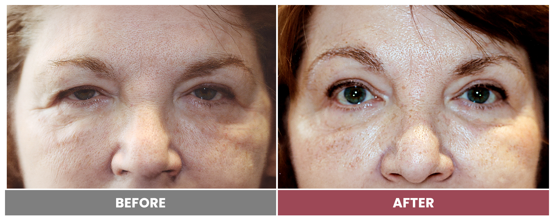 Upper Blepharoplasty - Case 56